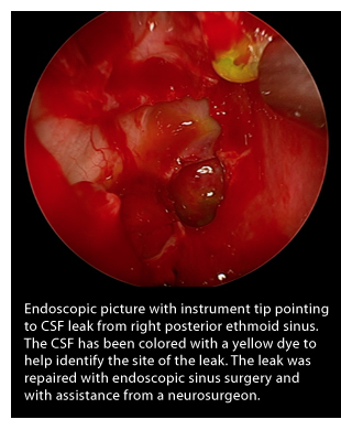 Cerebrospinal fluid leak